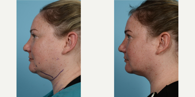 Woman treated with PrecisionTx - Woman treated with PrecisionTx