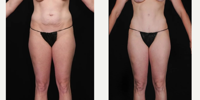 35-44 year old woman treated with SAFELipo - This patient received SAFEliposuction in our practice.