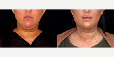 38 year old woman treated with PrecisionTx - 38 year old woman treated with PrecisionTx. Photos depict before and 1 month after treatment.