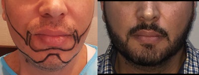35-44 year old man treated with Beard Transplant - Full Beard Transplantation by FUEGraft number: 4750 single