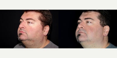 52 year old man treated with IPL - 52 year old man treated with IPL for Rosacea