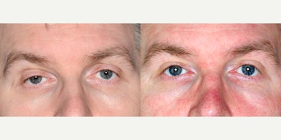 45 year old man treated with Ptosis Surgery - 45 year old man treated with Ptosis Surgery. Photos depict before and one year after surgery.