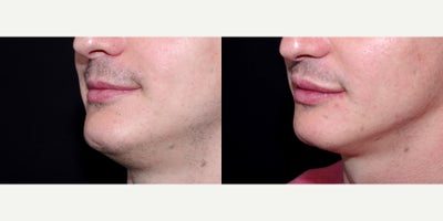 34 year old man treated with Lip Implants - 34 year old man treated with Lip Implants. Photos depict before and 1 month after surgery.