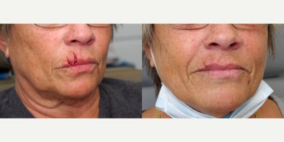 70 year old female treated with Scar Revision - 70 year old female treated with Scar Revision. Photos depict before and 6 weeks after surgery.