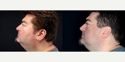 52 year old man treated with IPL - 52 year old man treated with IPL for Rosacea