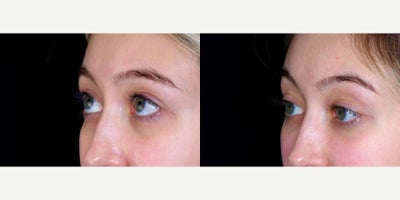 24 year old woman treated with Restylane Lyft to undereyes. - 24 year old woman treated with Restylane Lyft to undereyes. Photos depict before and 1 month after treatment.
