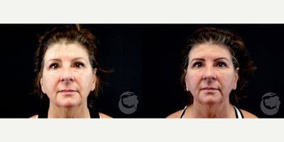 57 year old woman treated with Thread Lift - 57 year old woman treated with Thread Lift. Photos depict before and 1 month after 8 Silhouette Instalift Sutures.