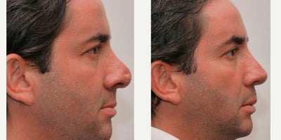 45-54 year old man treated with Polly-Beak -  Revision Rhinoplasty - 2 previous operations, left him with a blocked nose and a Polly-beak deformity (AKA Parrot-beak) . -a thick bulbous shapeless nasal tip with a divot
