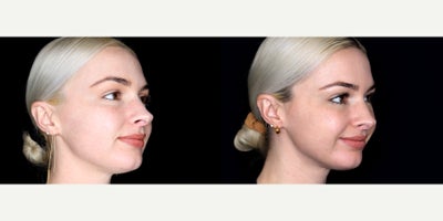 27 year old woman treated with Thread Lift - 27 year old woman treated with Thread Lift. Photos depict before and 1 month after 10 novathreads.