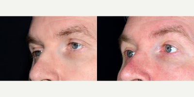 45 year old man treated with Ptosis Surgery - 45 year old man treated with Ptosis Surgery. Photos depict before and one year after surgery.