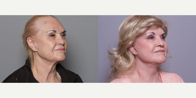 65-74 year old woman treated with Mini Lift - 65-74 year old woman treated with Mini Lift