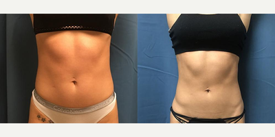 25-34 year old woman treated with Emsculpt - Emsculpt