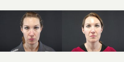 35-44 year old woman treated with Kybella - 38 year old female received Kybella to the submental area; photos depict the patients results 6 weeks post-op.