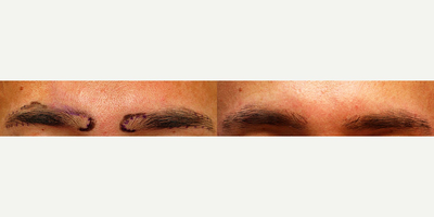 35-44 year old woman treated with Eyebrow Transplant - Eyebrow Transplant