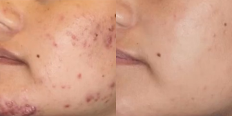 Patient treated with AviClear - Real Results. Real Skin Confidence. Dont let acne hold you back. Clear skin is possible with our customized acne treatment.AviClear is the first and original FDA-cleared device for the treatment of mild, moderate, and severe acne and provides you with a prescription-free approach to help you clear your skin.