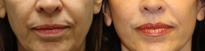 Lip Surgery - This beautiful woman came to see me concerned of the appearance of facial aging. One subtle signs of aging is the change in facial proportions. Particularly what is often overlooked is lip elongation. This can be improved with a lip lift procedure. Better balance is provided to the face with more youthful proportions. It give the appearance of filler without adding any volume.