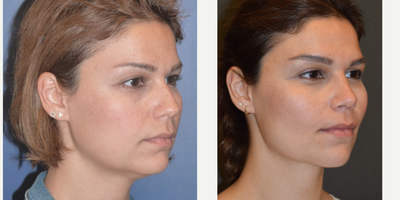 35-44 year old woman treated with Buccal Fat Removal - 35 years woman underwent Rhinoplasty, buccal fat removal ( Bichectomia) and neck liposuciton. An aesthetically appealing midface can be defined through five components: a distinct transition between the anterior border of the parotid gland and cheek hollow, a visible posterior border of the nasolabial fold, a subtle submalar depression, prominent zygomatic eminences, and a well-defined mandible, particularly the angle. Via buccal fat removal w/wo fillers and masseteric botox we can reach these goals.P.S: Buccal fat pad removal is an effective technique for refining the facial silhouette that should be reserved for patients with increased buccal fat pad volume. Removal of only the excessive portion of the fat pad is important because this structure provides significant volume in the midface that can be difficult to restore once aging affects the surrounding soft and bony tissue.
