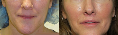 Woman treated with Lip Surgery - Woman treated with Lip Surgery
