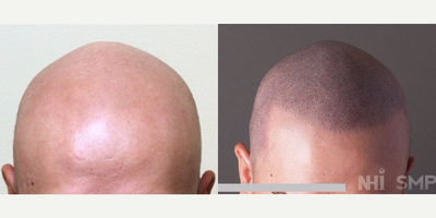 25-34 year old man treated with Scalp Micropigmentation Alopecia Totalis - Scalp Micropigmentation Alopecia Totalis (This patient had absolutely no hair)