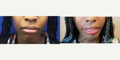 Patient treated with Chin Surgery - Chin Implant (Central) with Reduction and Contour - 25 to 34 year-old female patient is 5 months post-op from Facial Feminization surgery. Her procedures included: Forehead Lift, Hairline Lowering, Orbital Bony Contouring; Chin Implant (Central) with Chin Reduction and Contour; Cheek Implants (Small); Thyroid Cartilage Shave and Voice Feminization; Fascia to Upper Lip; Internal Lip Lift; Septorhinoplasty (Closed) with Cartilage Grafts.