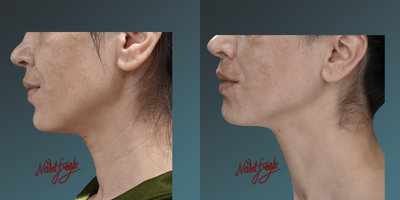 35-44 year old woman treated with Thermage FLX - 35-44 year old woman treated with Thermage FLX