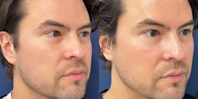 Man treated with Dermabrasion, Skin Rejuvenation - Dreaming of radiant, luminous skin? Our Diamond Glow Facial is your secret weapon.This luxurious treatment dives deep into your pores to cleanse away dirt and grime, while the gentle diamond microdermabrasion reveals a smoother, more vibrant complexion.