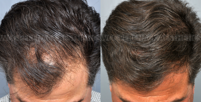 55-64 year old man treated with Hair Transplant - This patient was treated in the front hairline for thinning. He received 1000 grafts.