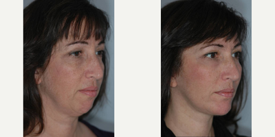 Fat Injections, Chin Implant, Submental Liposuction, Facelift, Lower Lid 88% Phenol Peel - 51 year old female with complaints of a weak chin, jawline and neck line. It has been a lifelog problem for her but it has gotten worse with age. She is also concerned with her lower eyelids and a tired look. Patient underwent Fat Injections, Chin Implant, Submental Liposuction, Facelift, Lower Lid 88% Phenol Peel. Photos show her 1 month post op.