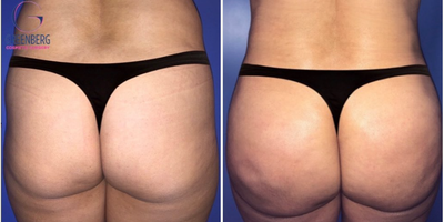45-54 year old woman treated with Liposuction, Butt Augmentation, Butt Lift - Liposuction + Fat TransferDuring fat transfer surgery, fat cells are transferred typically from the lower back, waist, flanks (love handles), thighs and stomach. Fat injection achieves a more natural result, has a lower risk of infection, and also contours the areas around the buttocks to enhance the overall effect. Since fat transfer uses your bodys own tissues, generally, the body does not reject the cells and the results are a soft and natural look. Patient is 45 year old female and two months post op her BBL.