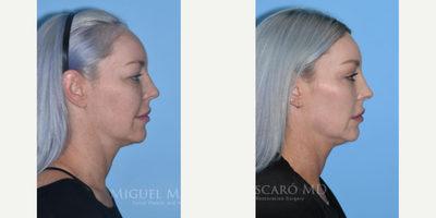Woman treated with Forehead Reduction - Woman treated with Forehead Reduction (hairline advancement)and Brow Lift. Patient is shown before and 1 year post-op.