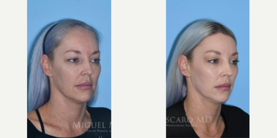 Woman treated with Forehead Reduction - Woman treated with Forehead Reduction(hairline advancement)and Brow Lift. Patient is shown before and 1 year post-op.