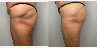 55-64 year old woman treated with Radiesse, Morpheus8 - patient had a combination of morpheus8 treatment and radiesse fillers