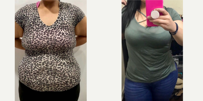 25-34 year old woman treated with Tummy Tuck, Liposuction, Brazilian Butt Lift - Excellent outcome after intense liposuction including abdomen, waist, laterals and upper and lower back to improve your body contour and get better curves, especially in your waist area and dominican butt lift.