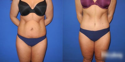 Woman treated with Tummy Tuck - Woman treated with Tummy Tuck