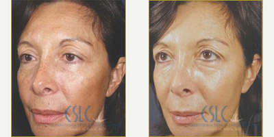 45-54 year old woman treated with Vi Peel - Vi Peel