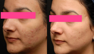 25-34 year old woman treated with eMatrix - eMatrix 2 months after patient's first treatment. Patient continuing two more treatments for further refinement.