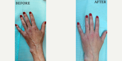 45-54 year old woman treated with Hand Rejuvenation - Before and after hand rejuvenation: 49 year-old with some volume loss. Added 2 syringes of restylane mixed with 1/2 a syringe of Radiesse. The Radiesse is a biostimulator. So it will help the skin to produce more of its own collagen, elastin, and fibroblasts.