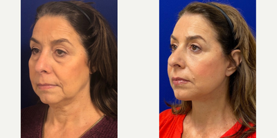 57 year old woman treated with Eyelid Surgery - 57 year old woman treated with Eyelid Surgery through upper and lower blepharoplasty as well as Facelift, Neck Lift, and Facial Fat Transfer, shown 3 months post op.