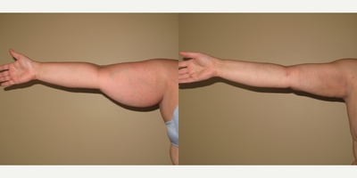 35-44 year old woman treated with Renuvion - Liposuction and Renuvion to arms