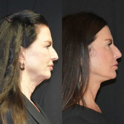 55-64 year old woman treated with Facelift, Neck Lift, Facial Fat Transfer - 6 months post op Facelift/ neck lift with fat transfer to face