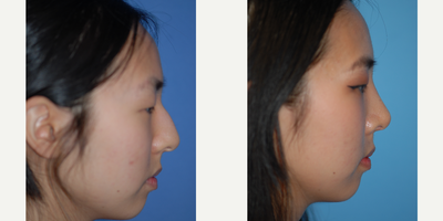 18-24 year old woman treated with Asian Rhinoplasty - Rhinoplasty to correct a bump and droopy tip and create a nice profile.