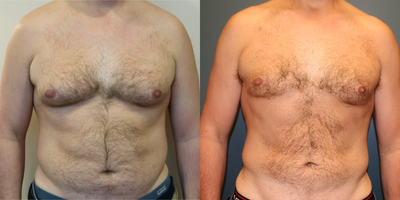 45-54 year old man treated with Male Breast Reduction - This patient had vaser lipo with the extra skin tightening of the smart lipo for Gynecomastia ( male breast enlargement).  We also treated his abdomen, flanks and upper and lower back. additional improvement over the next 4 months is expected.