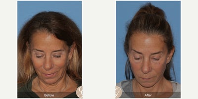 67 year old woman treated with Lower Facelift, Deep Plane Facelift, Facelift, Facial Fat Transfer, Earlobe Repair - 67 year old woman treated with Lower Face and Deep Plane Neck Lift, Fat Grafting to Face, Earlobe Reduction, Under Eye Laser