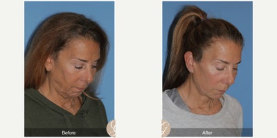 67 year old woman treated with Lower Facelift, Deep Plane Facelift, Facelift, Facial Fat Transfer, Earlobe Repair - 67 year old woman treated with Lower Face and Deep Plane Neck Lift, Fat Grafting to Face, Earlobe Reduction, Under Eye Laser
