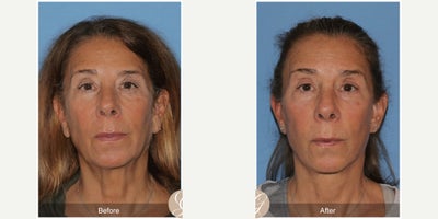 67 year old woman treated with Lower Facelift, Deep Plane Facelift, Facelift, Facial Fat Transfer, Earlobe Repair - 67 year old woman treated with Lower Face and Deep Plane Neck Lift, Fat Grafting to Face, Earlobe Reduction, Under Eye Laser