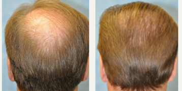 55-64 year old man treated with Hair Transplant - Hair Transplant with NeoGraft