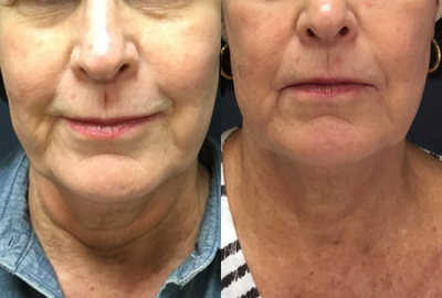 55-64 year old woman treated with TempSure Envi - 3 sessions to face and neck