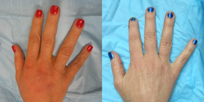 Case #Hand rejuvenation Patient - Plumping the hands via fillers can help avoid the veiny bony  look of older appearing hands. In this case we used Radiesse filler.