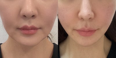 35-44 year old woman treated with Lipodissolve - Fat-dissolving injections to contour the facial line