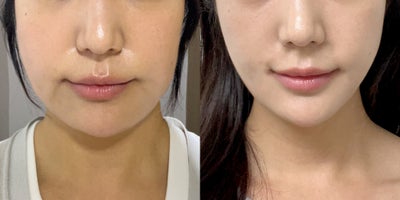 25-34 year old woman treated with Lipodissolve - Fat-dissolving injections to contour the facial line